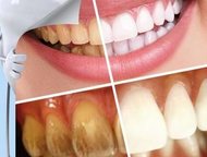    : Teeth cleaning kit    1 . 
       . 
  ,  -   